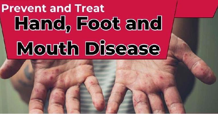 Protect yourself against Hand, Foot and Mouth disease | News Extra ...