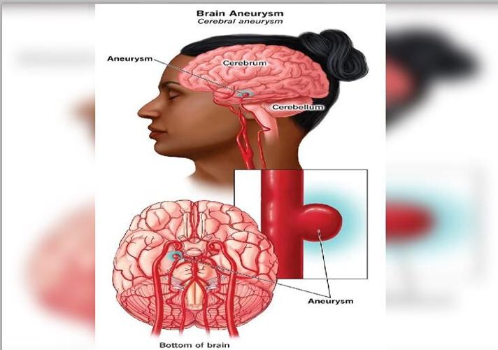 Brain aneurysm | Features Local | trinidadexpress.com