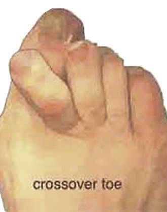 What is a crossover toe deformity | Local News | trinidadexpress.com