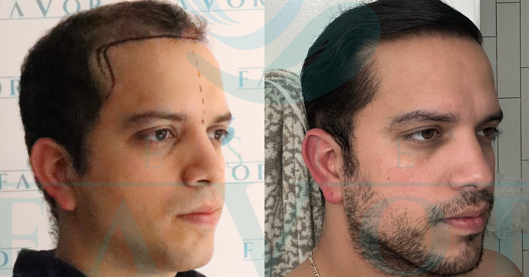 Popular 2025 Hair Transplant Clinics in Turkey