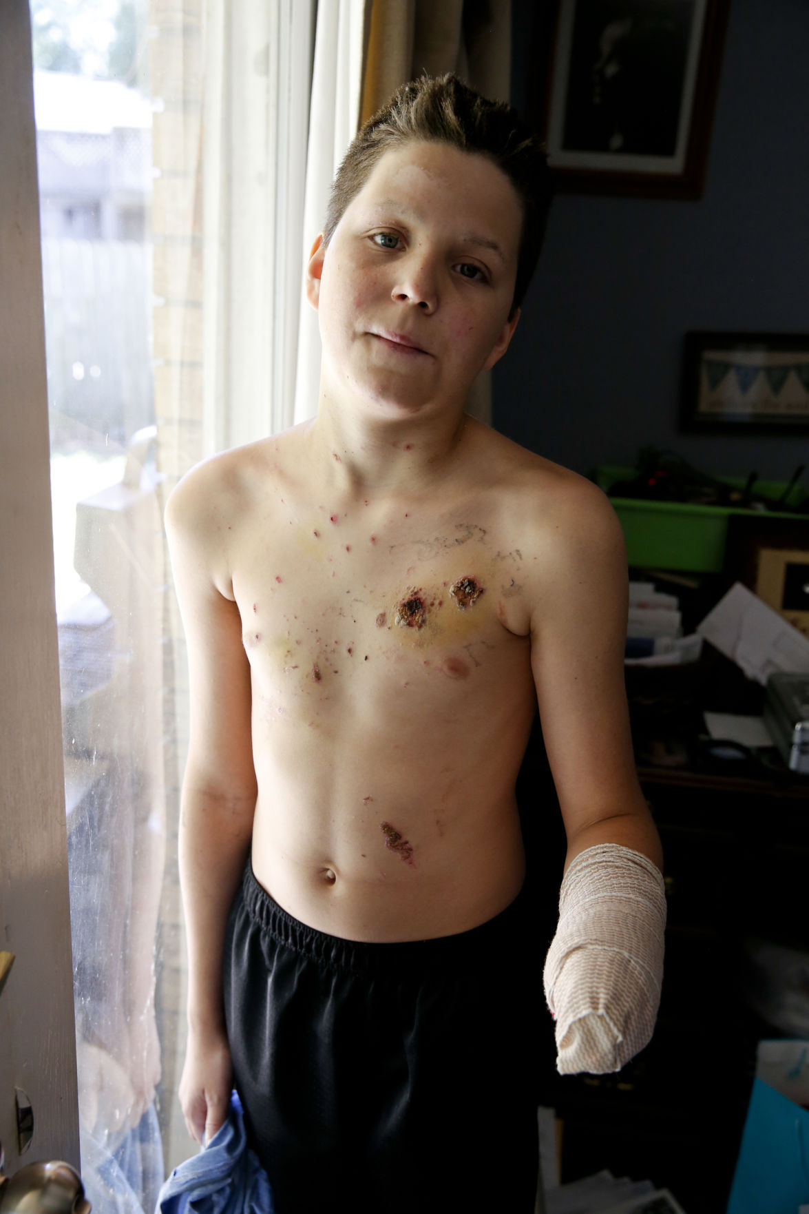 After Broken Arrow teen loses hand in fireworks accident