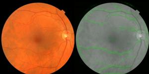 In our eyes, Google's software sees heart attack risk