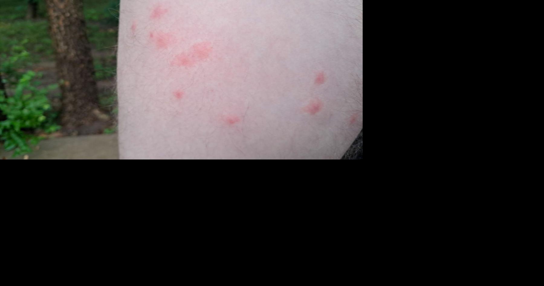 Chigger warning for Oklahomans amid warm, wet weather surge