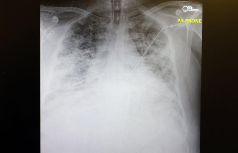 Saint Francis Covid cases