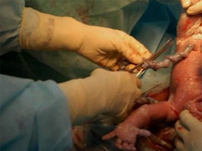 Don T Cut That Umbilical Cord Too Soon Wait A Minute Health