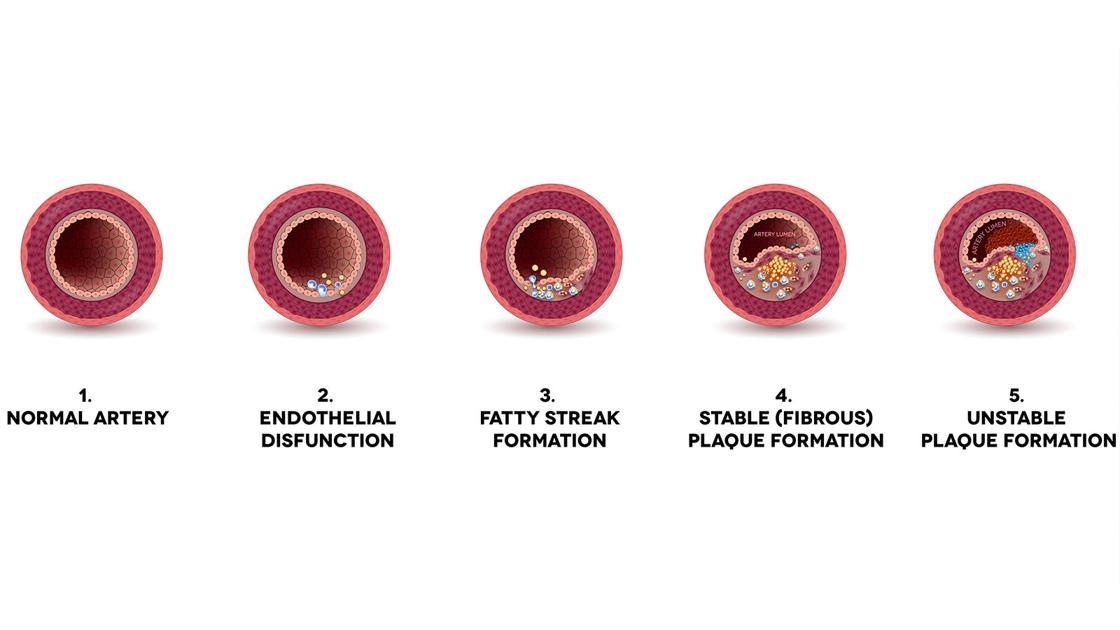 Should I be concerned about hardening of the arteries? Health