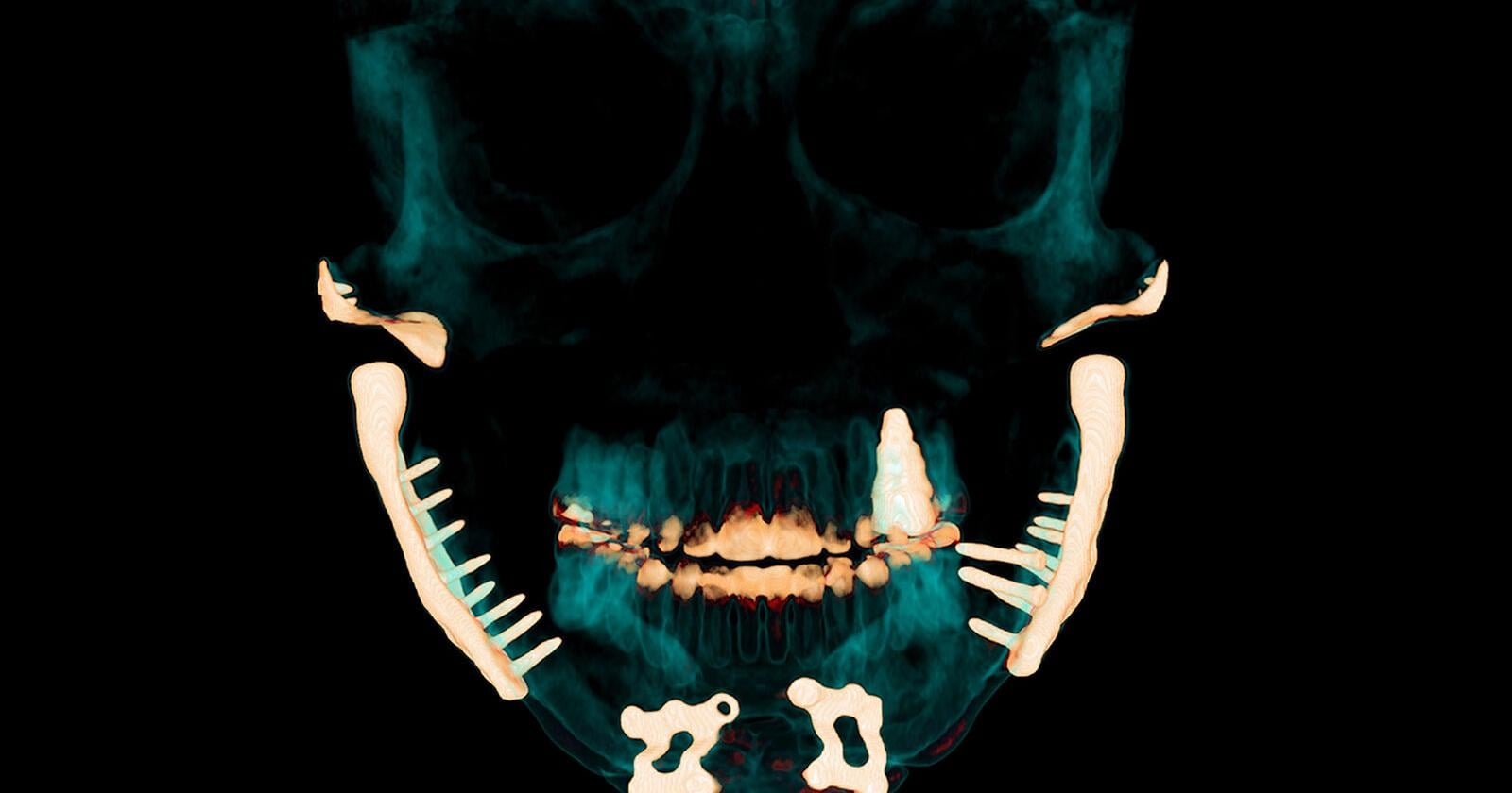The horrors of TMJ: Chronic pain, metal jaws and futile treatments - Vimarsana News