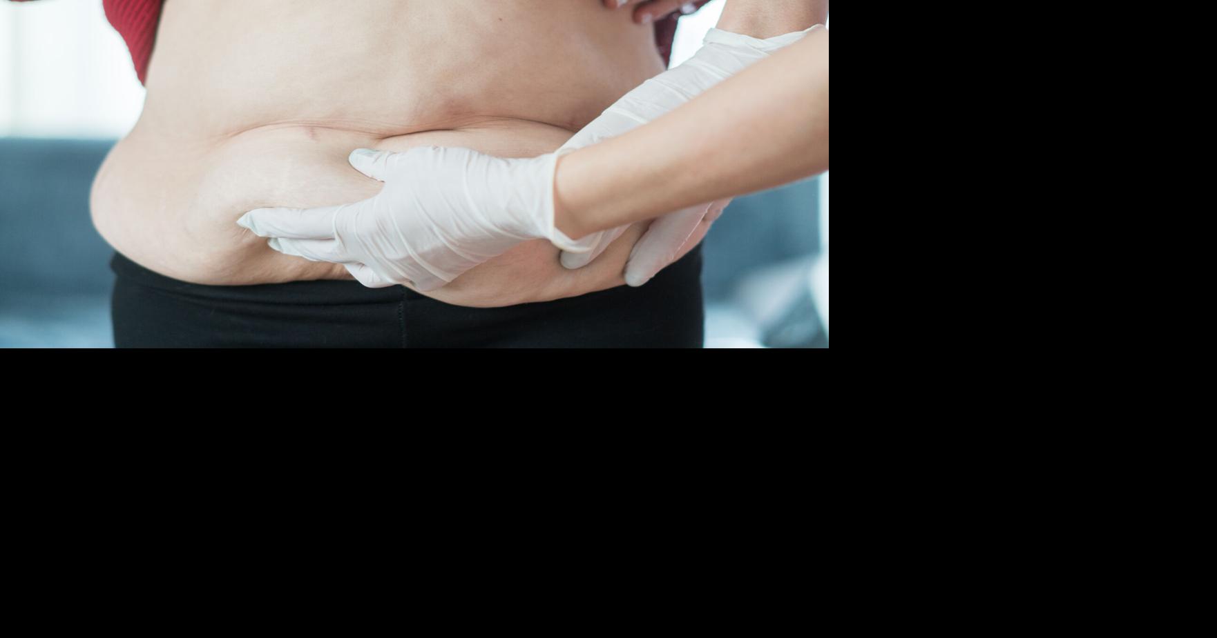 After the weight loss: GLP-1 medications spike demand for cosmetic surgery