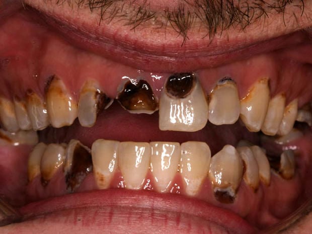 Rotten Teeth? Try These Five Ways To Fix Them!