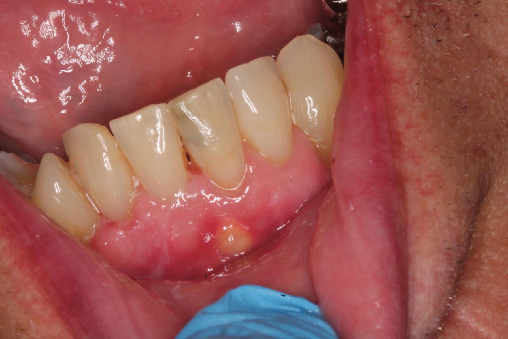 Check replacement ... mouth joint infection for before having