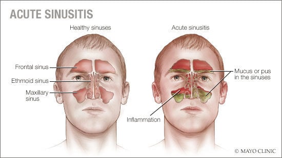 Sinusitis acute deals