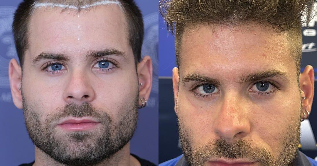 Top 15 Best Hair Transplant Clinics in Istanbul, Turkey (2026 List)