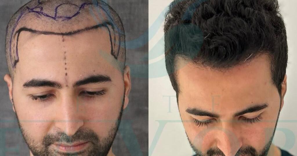 Top 10 Best Hair Transplant Clinics in Turkey: Exclusive 2026 Report on Technology, Cost, and Results