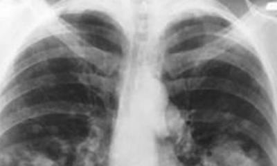 Lung cancer rates rising in the United States