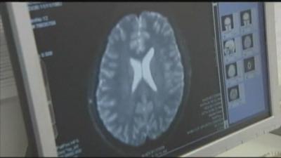 brain scan epilepsy awareness