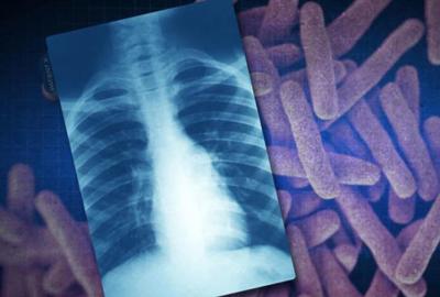 Tuberculosis