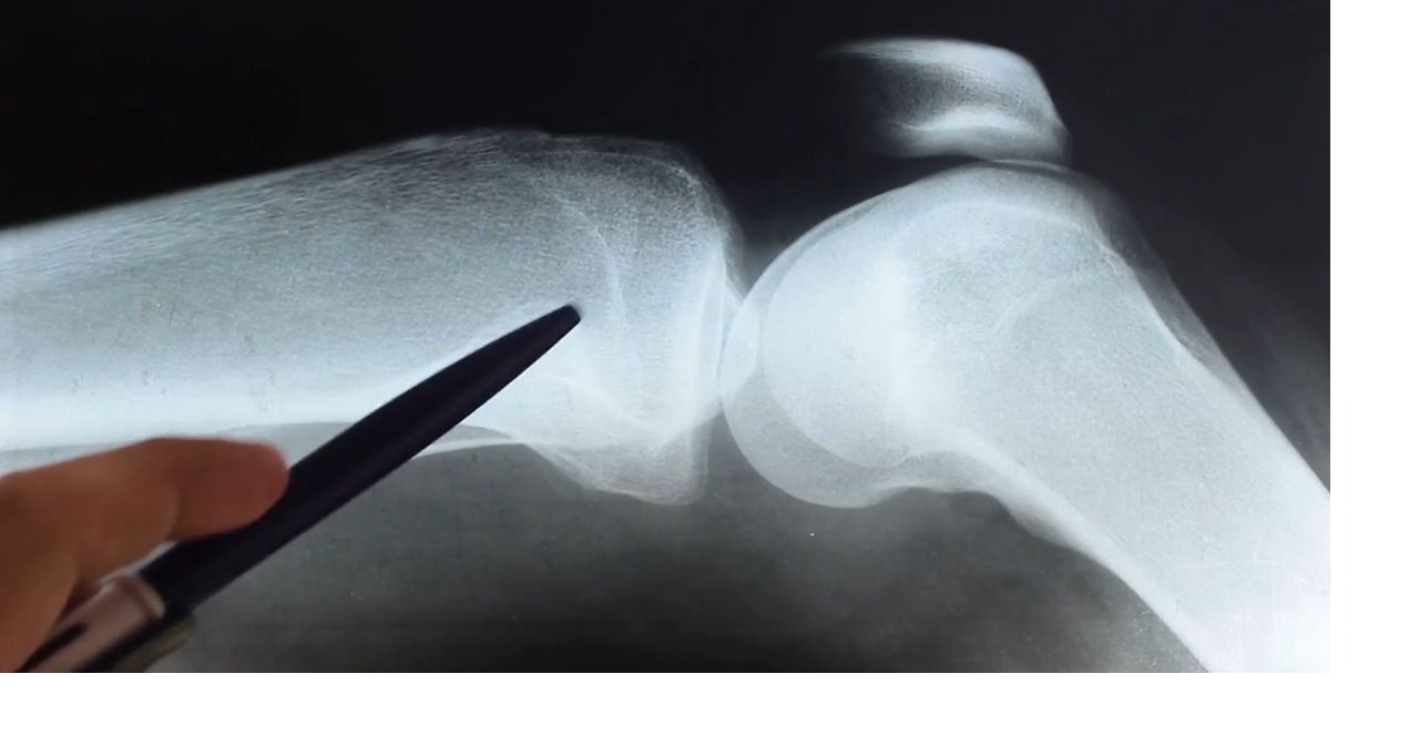 Medical Minute | Gout