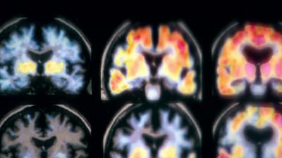 alzheimers