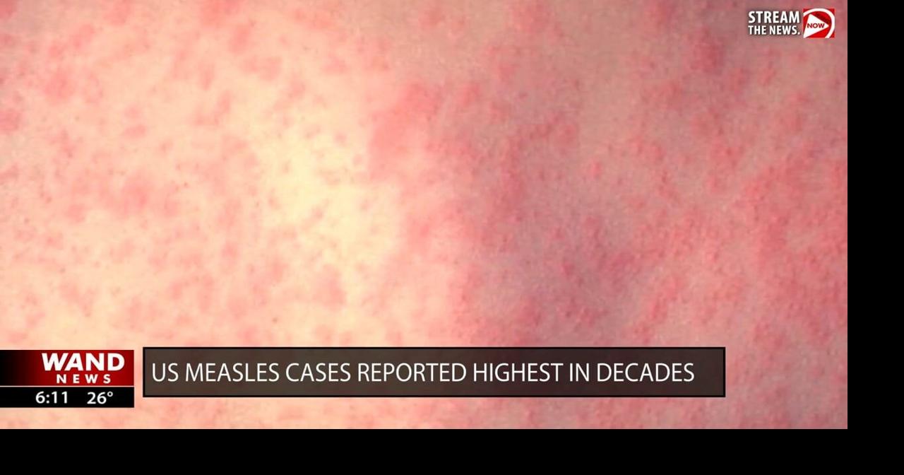 U.S. measles cases reported highest in decades