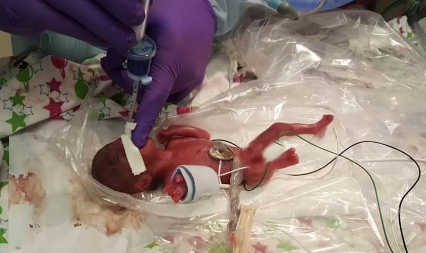World's Smallest Baby 1