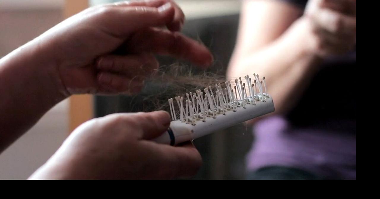Area doctors say hair loss linked to COVID19 stress News