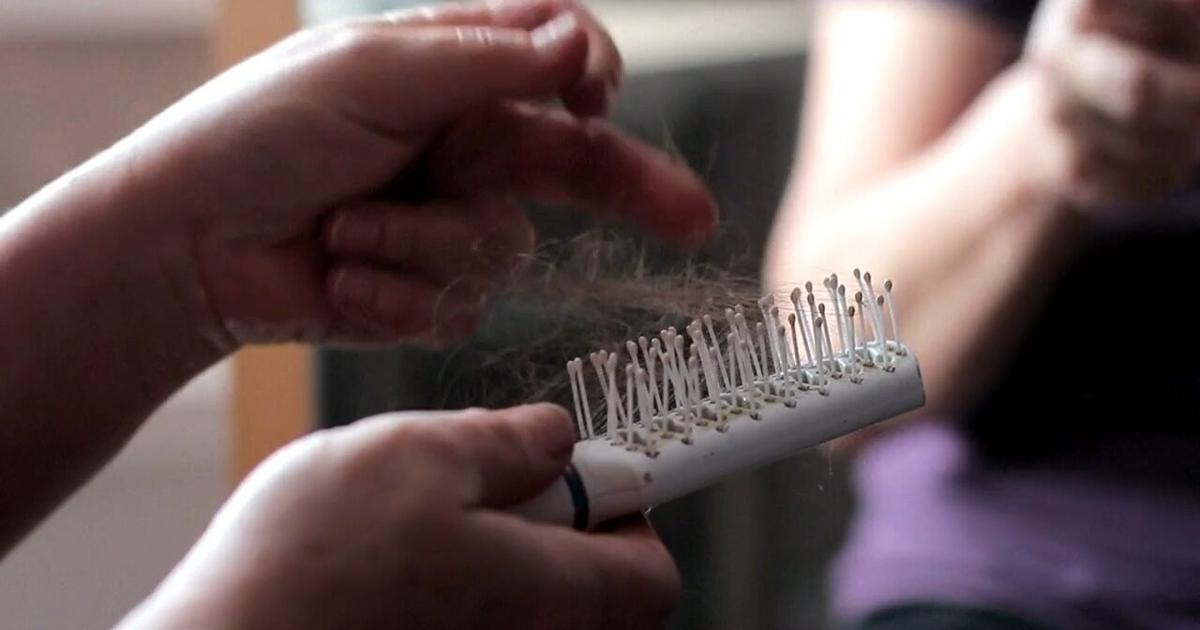 Area Doctors Say Hair Loss Linked To Covid 19 Stress News Waow Area Doctors Say Hair Loss Linked To Covid 19 Stress News Waow