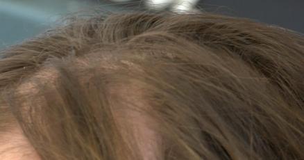 Wausau woman shares story living with hair-loss disease | Top Stories |  