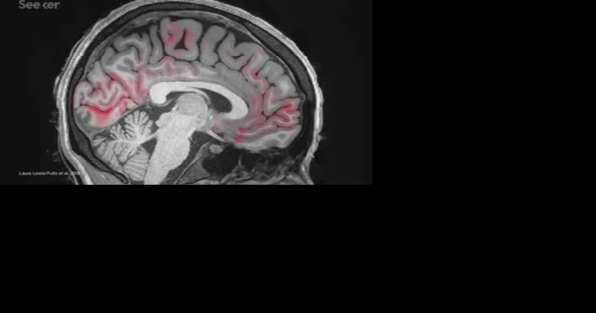 Alzheimer: factores de riesgo y cómo reducir las posibilidades de desarrollarlo