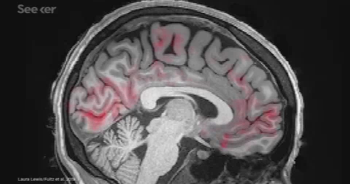 Alzheimer: factores de riesgo y cómo reducir las posibilidades de desarrollarlo