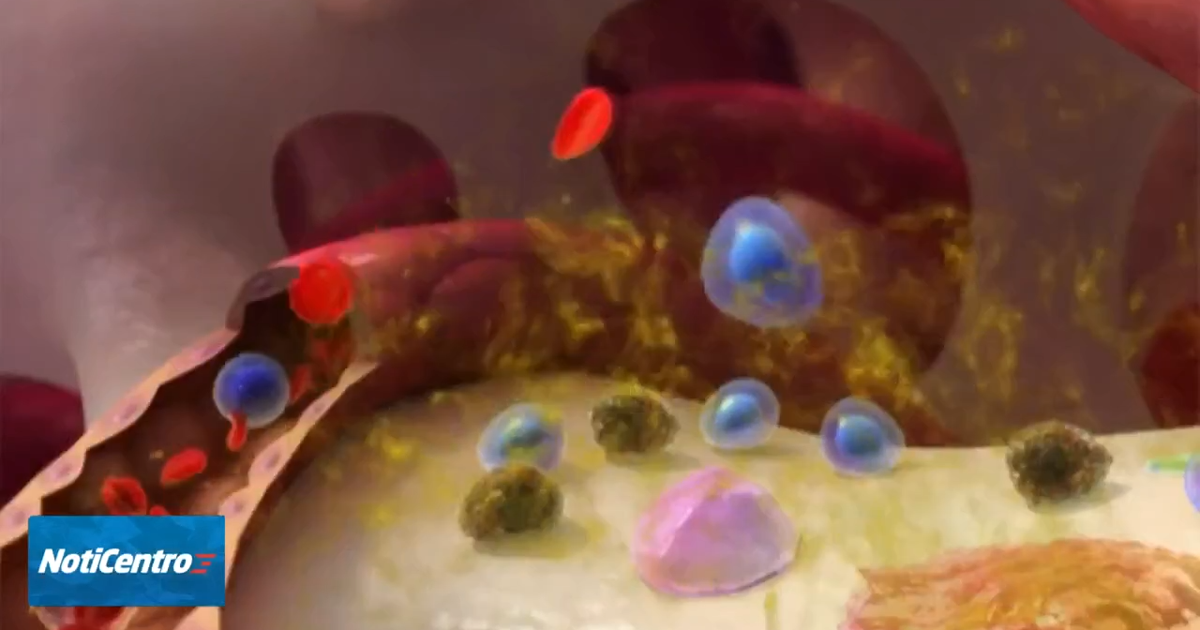 Car-T, nuevo tratamiento con células modificadas genéticamente para el mieloma múltiple