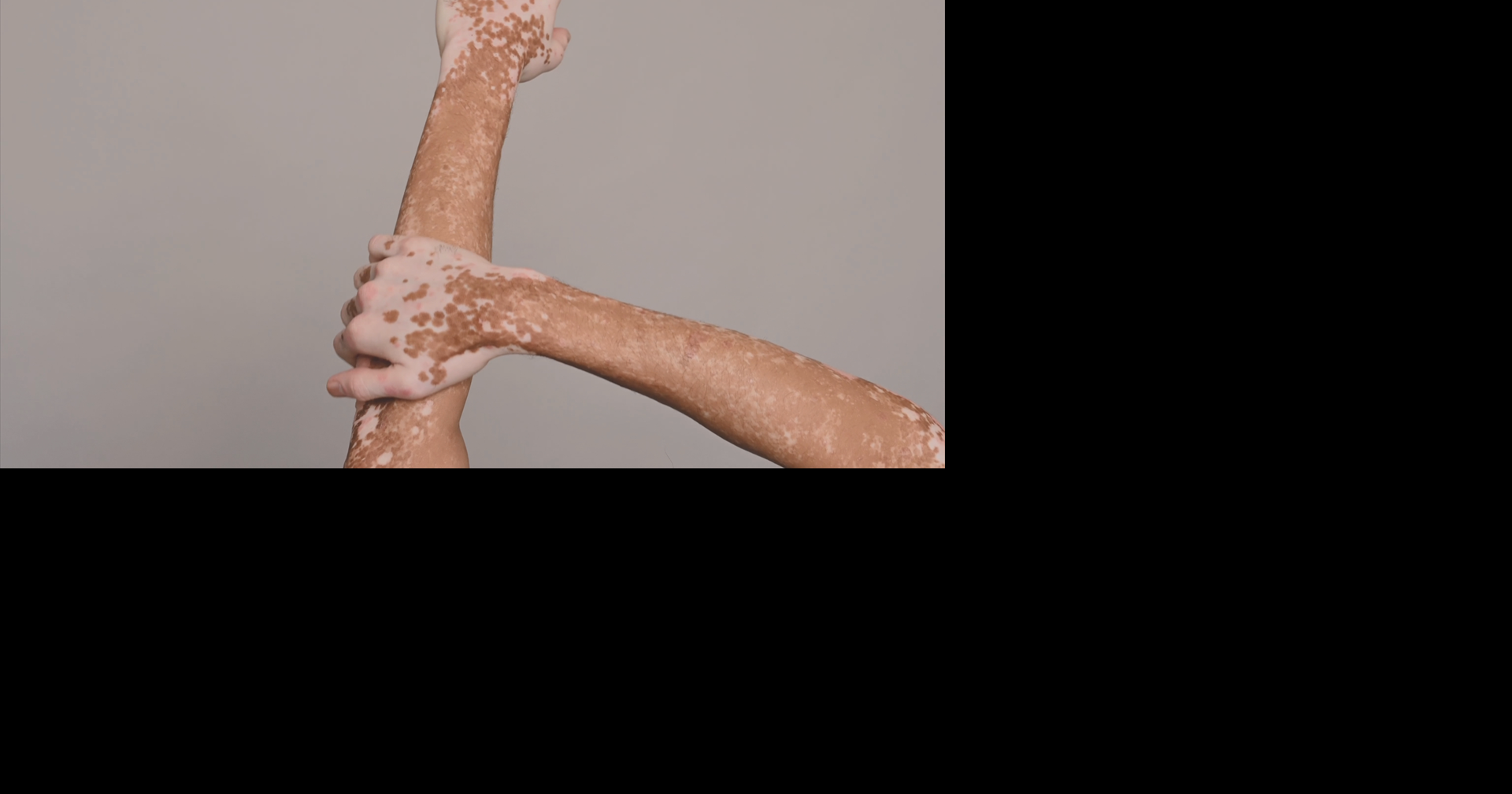 Día Mundial de la Psoriasis: buscan derribar mitos y mejorar acceso a tratamientos en PR