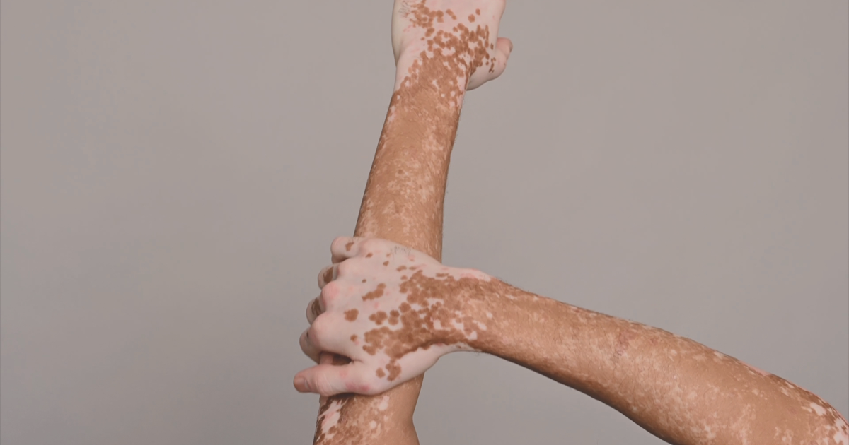 Día Mundial de la Psoriasis: buscan derribar mitos y mejorar acceso a tratamientos en PR