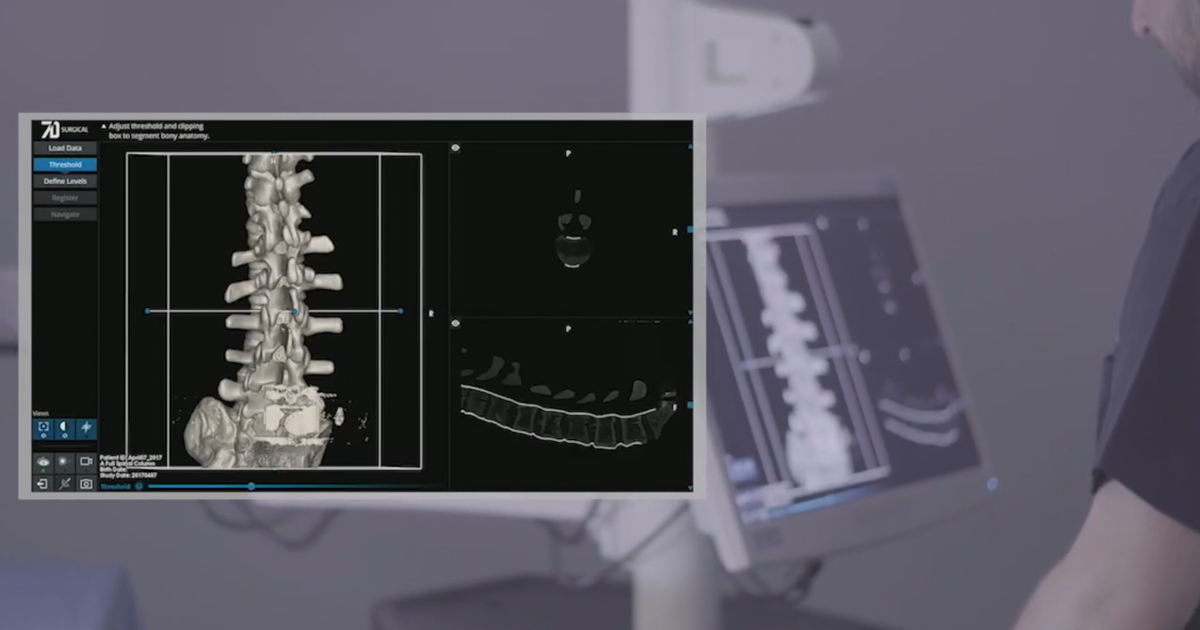 Conoce la nueva tecnología para tratar la escoliosis