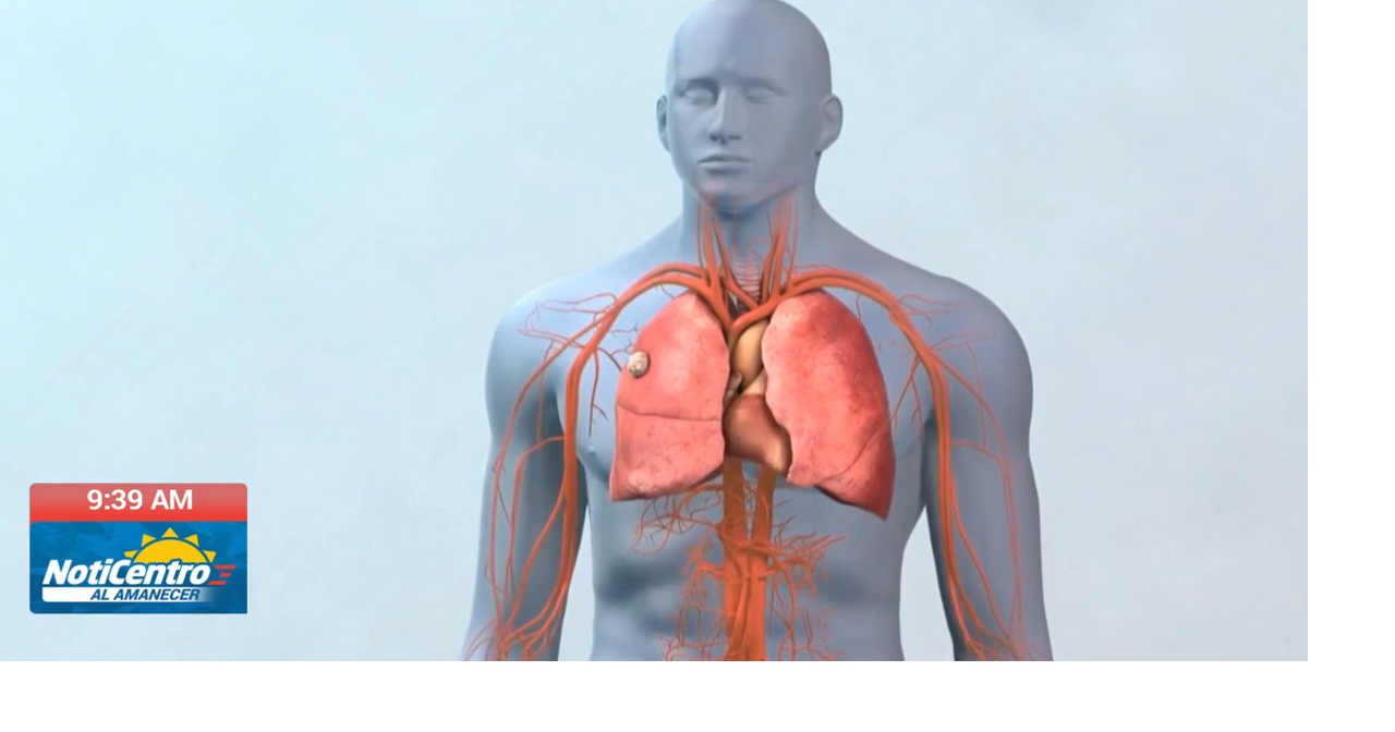 Detección temprana del cáncer pulmonar eleva supervivencia a más del 60%, advierte oncóloga