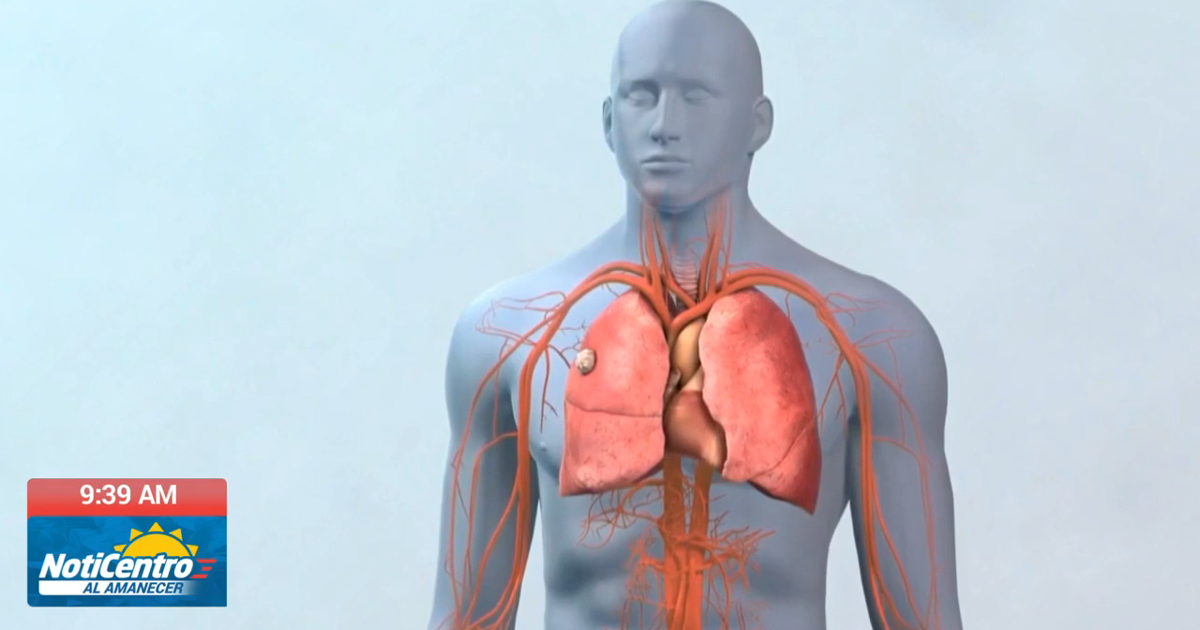 Detección temprana del cáncer pulmonar eleva supervivencia a más del 60%, advierte oncóloga