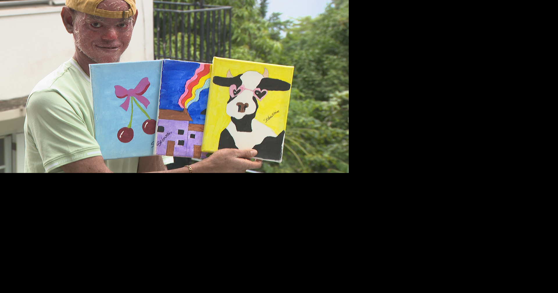 Joven con Ictiosis Lamelar halla en el arte refugio ante fallas del sistema educativo