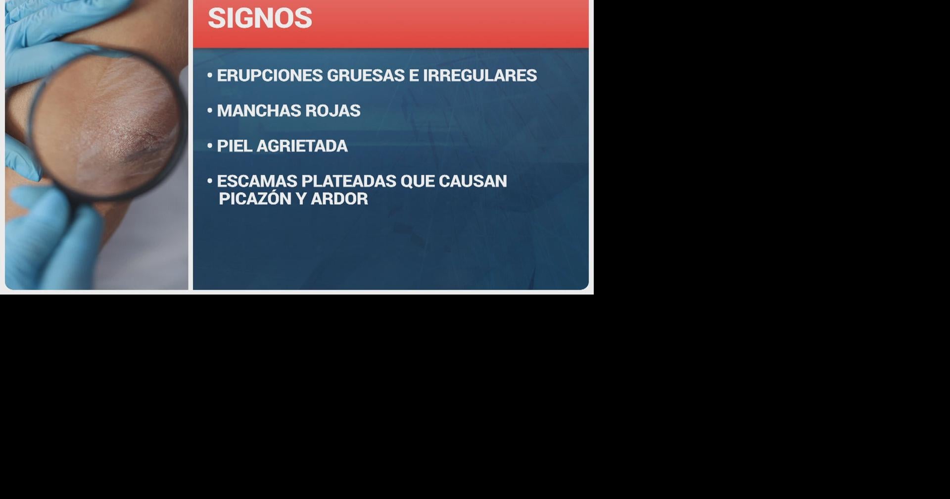 APAPP lanza campaña para combatir estigmas sobre la psoriasis: "Los abrazos son contagiosos, la psoriasis no"