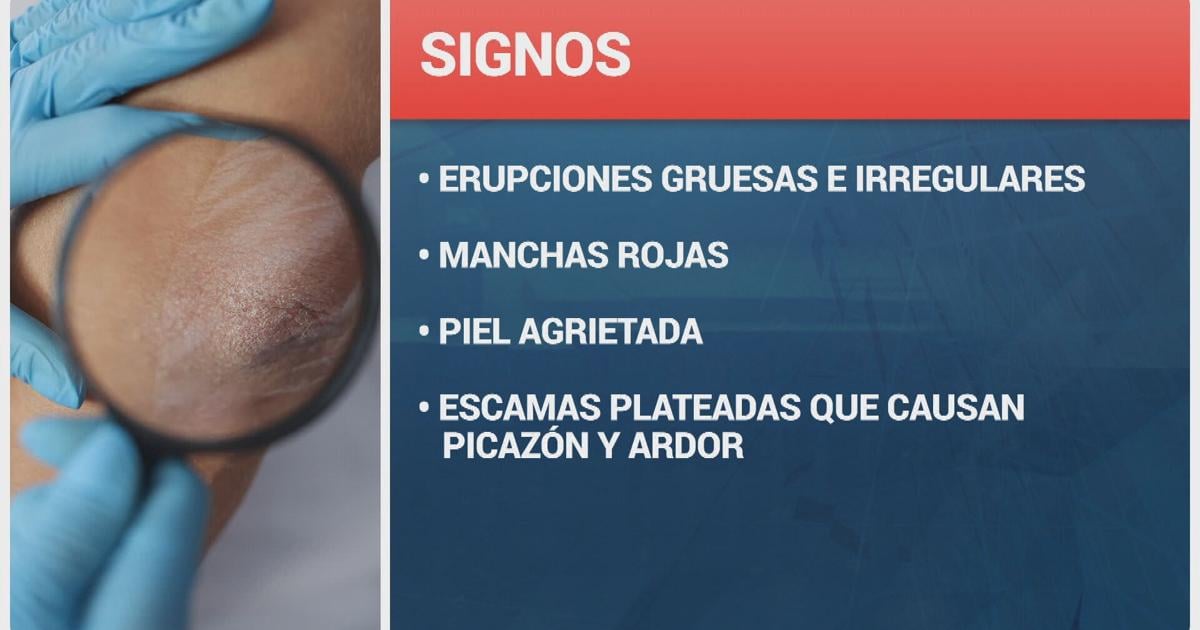 APAPP lanza campaña para combatir estigmas sobre la psoriasis: "Los abrazos son contagiosos, la psoriasis no"