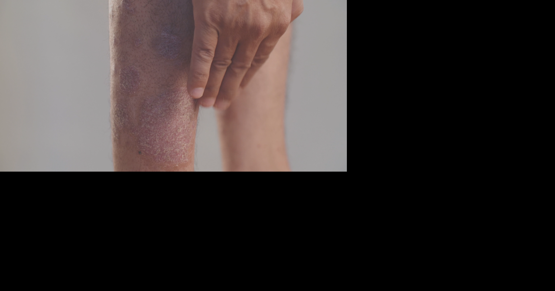 FDA aprueba Icotrokinra de Johnson & Johnson, nuevo medicamento oral para la psoriasis