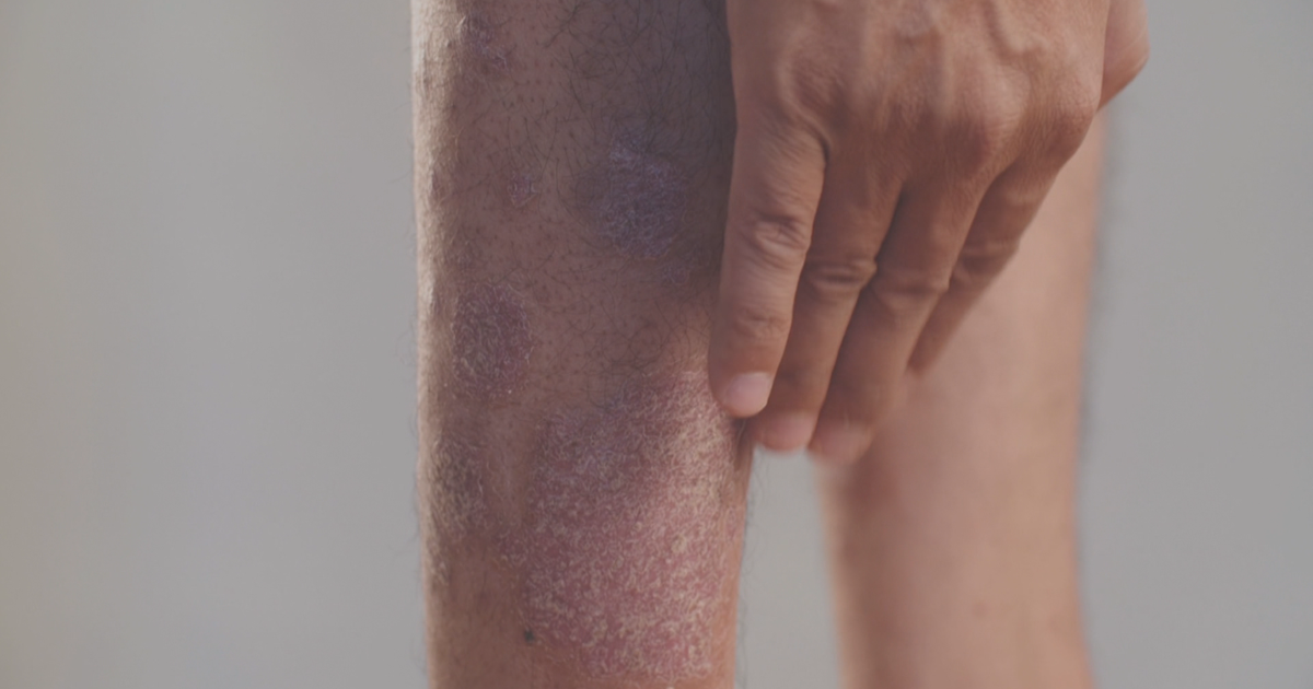FDA aprueba Icotrokinra de Johnson & Johnson, nuevo medicamento oral para la psoriasis