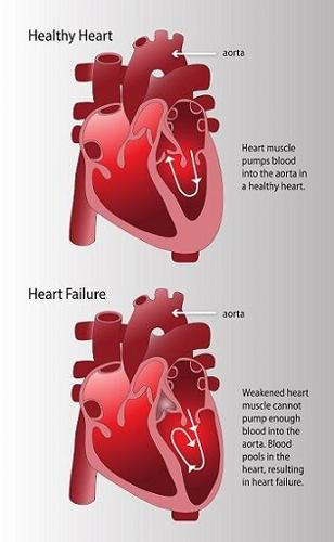heart_failure