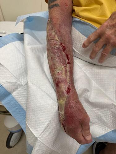 Vernon Lear's arm after battling a vibriosis infection