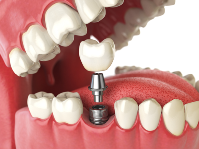 Radiant Smiles Dental Care Offers Full Mouth Implant Treatment for Albany Patients