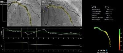 FAST III trial demonstrates non-inferiority of CAAS vFFR to invasive wire-based FFR