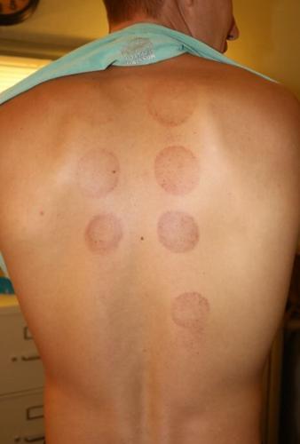 cupping