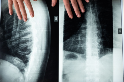 Advancing Bone Marrow Failure Treatment Through Stem Cell Transplantation