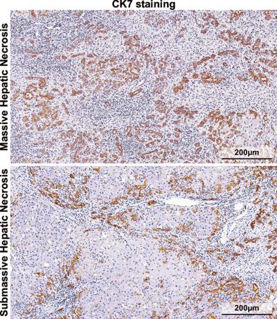 Massive Hepatic Necrosis Drives Acute Liver Failure: Mechanisms, Challenges and Clinical Potential