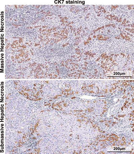 Massive Hepatic Necrosis Drives Acute Liver Failure: Mechanisms, Challenges and Clinical Potential