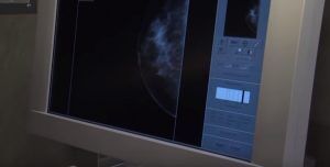 Breast Cancer Screening