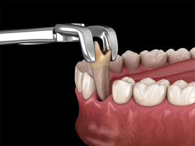 5 Things to Know About Tooth Extractions in Sioux Falls
